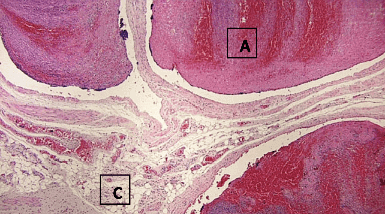 G-spot complex histology, microscopic image of anterior vaginal wall, trombosed blood vessels, nerve bundles, fibroadipose tissue
