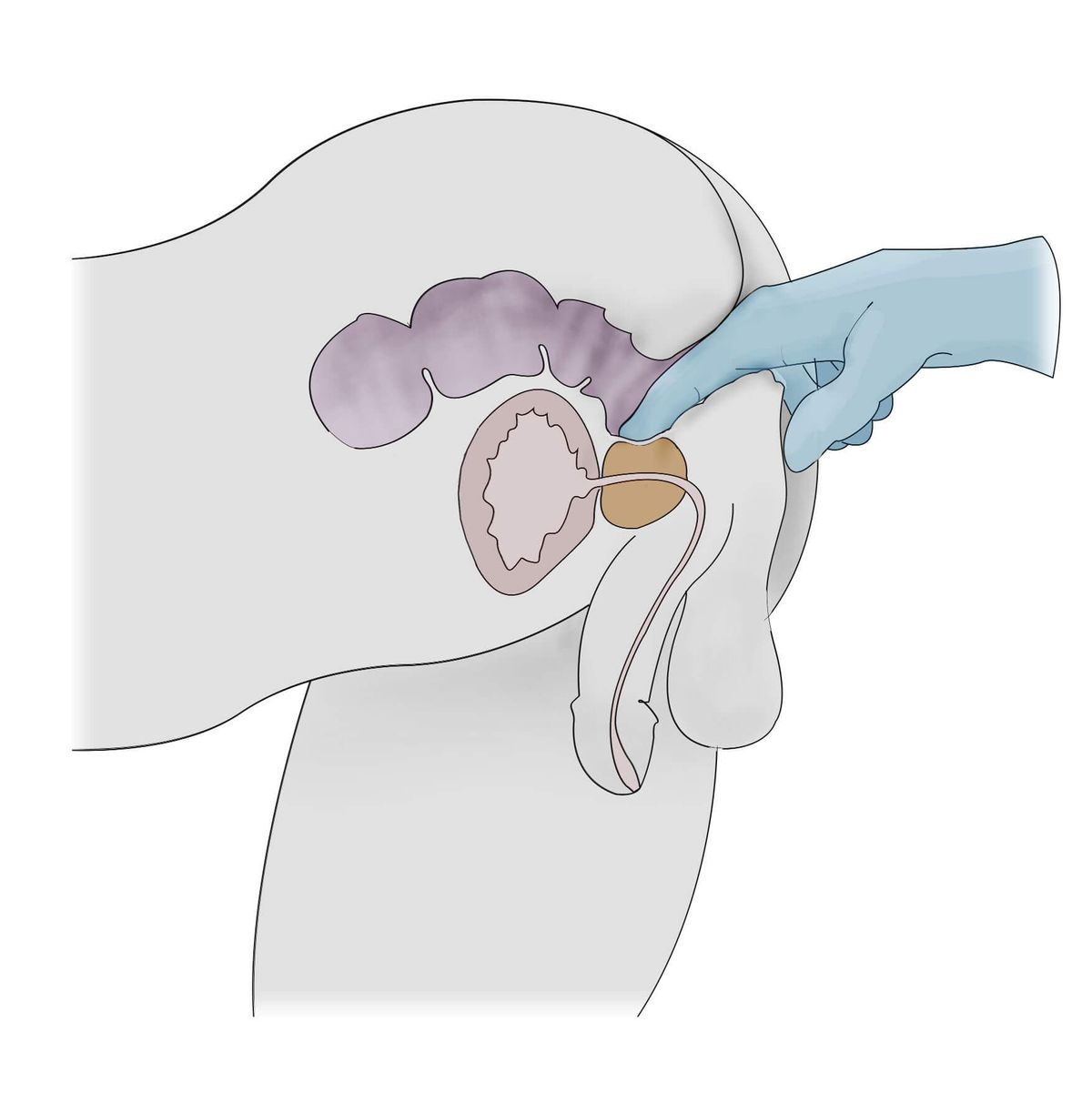 A drawing showing how the prostate is located during prostate examination
