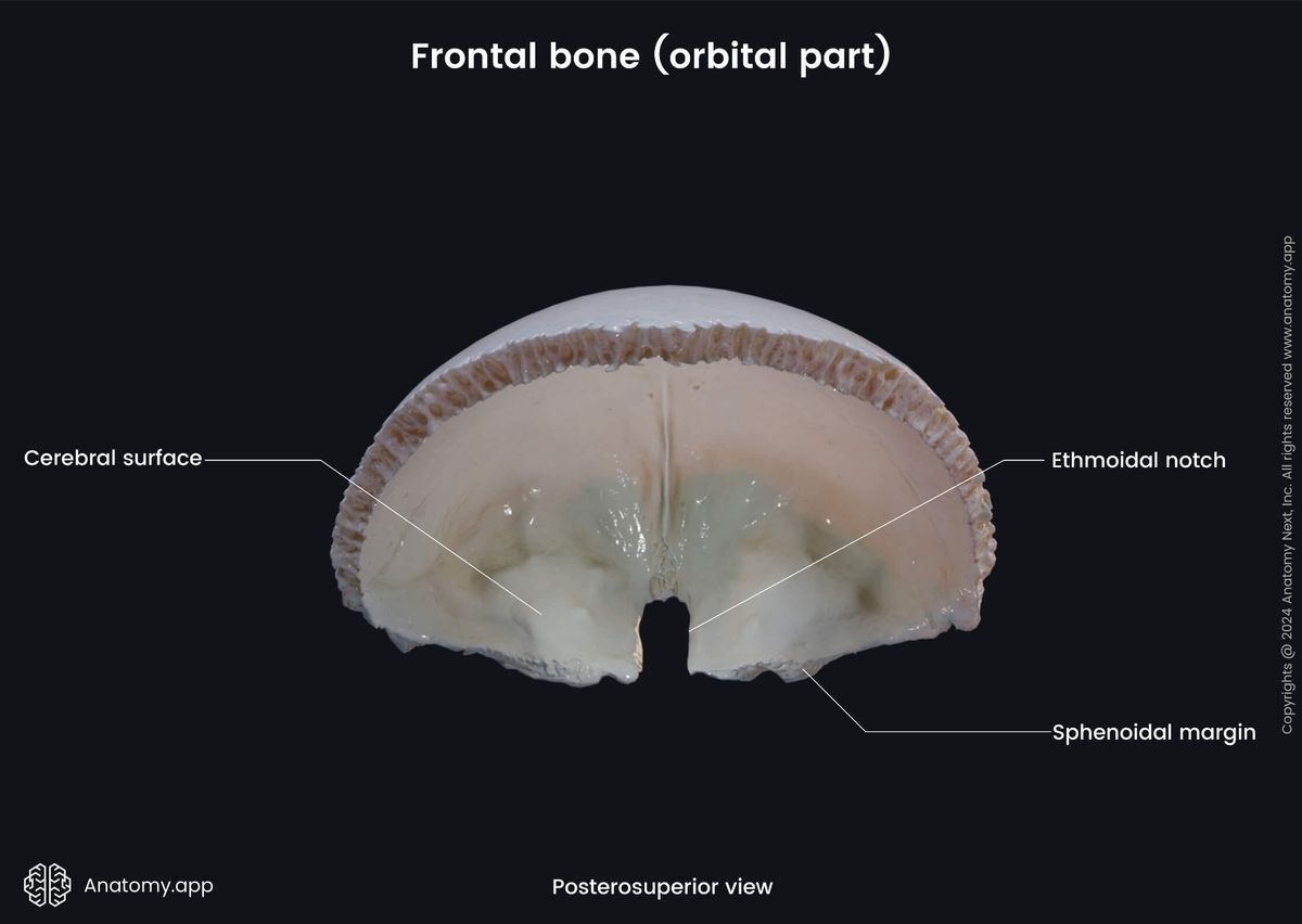 Head and neck, Skull, Cranium, Cranial bones, Neurocranium, Frontal bone, Landmarks, External surface, Squamous part, Posterosuperior view